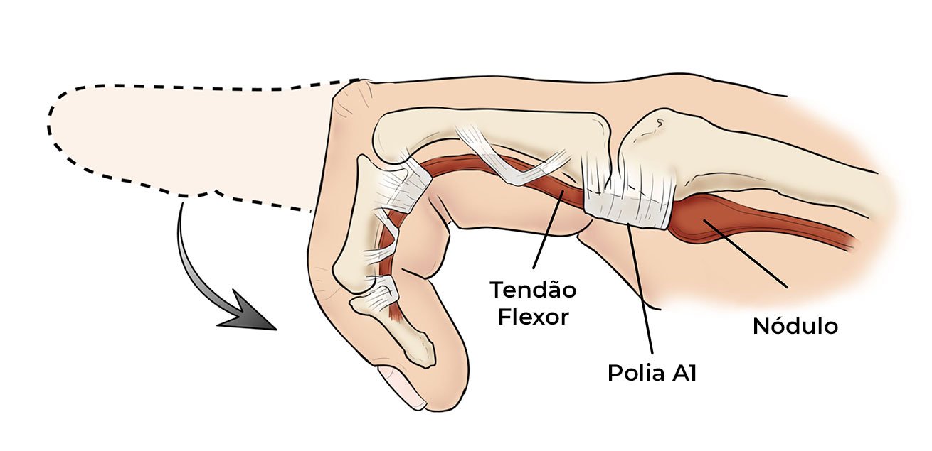 Dedo em Gatilho: Sinais e Sintomas – drpedrohenriquepires.com.br